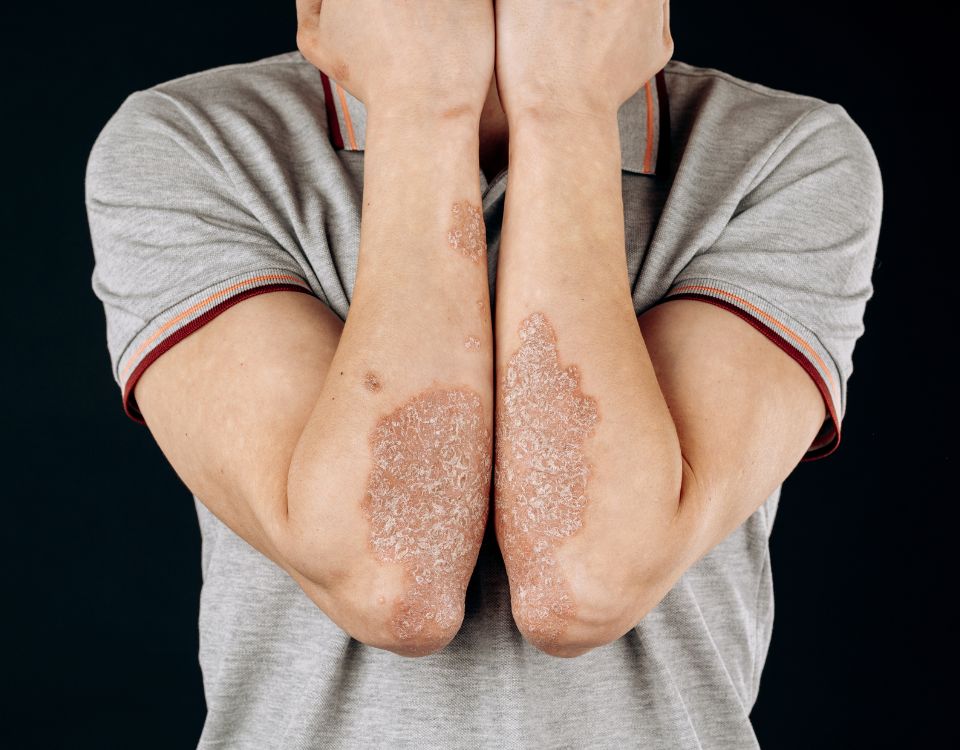 psoriasis